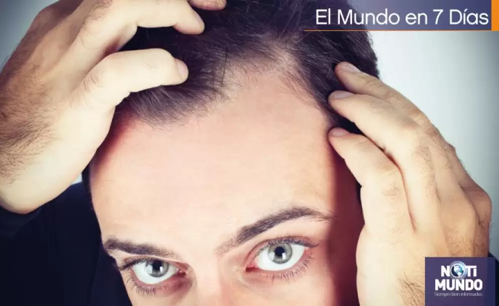 ¿Qué tratamientos existen actualmente para combatir la calvicie?