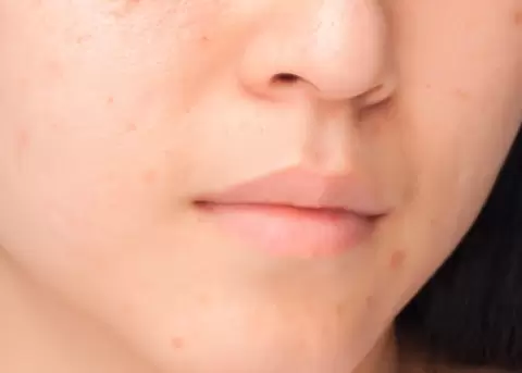 Manchas en el rostro post verano y cmo tratarlas