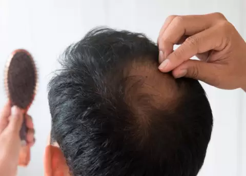 Salud: Alopecia y Calvicie, causas y tratamiento