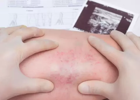 Salud: Trombosis venosa, qu es?