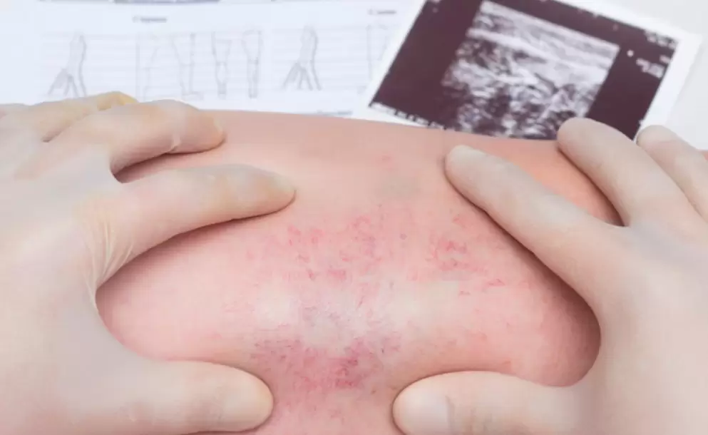 Salud: Trombosis venosa, qu es?