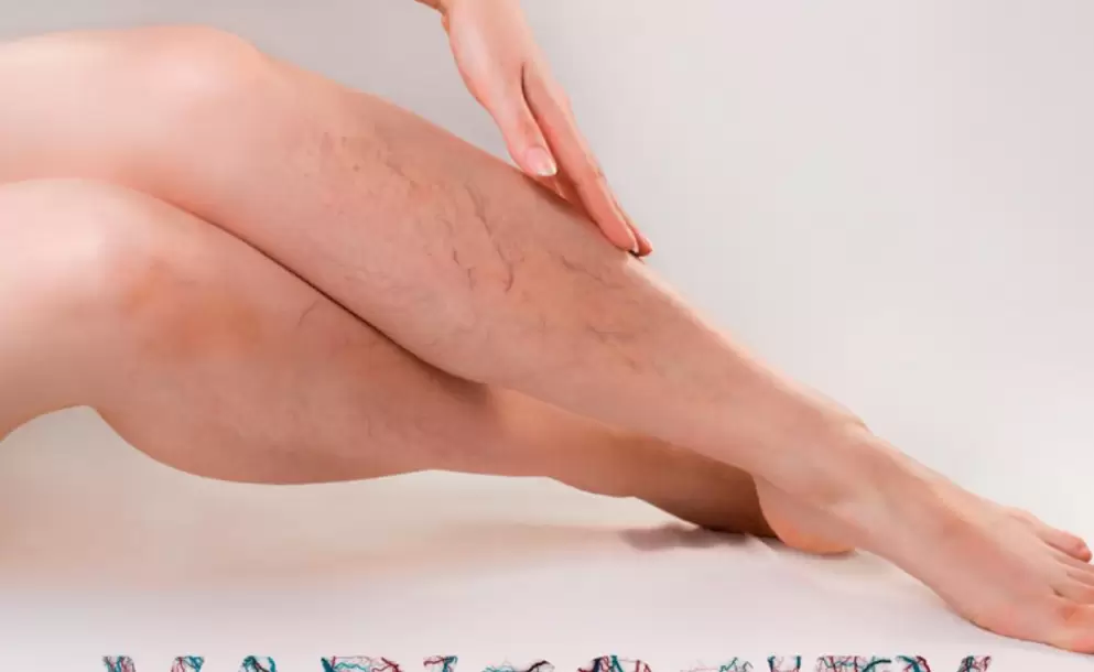 Es posible evitar la formacin de varices?