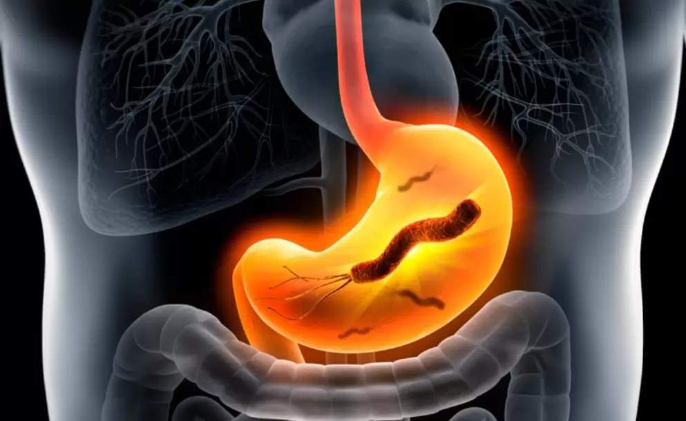 Causas y sntomas del Helicobacter pylori