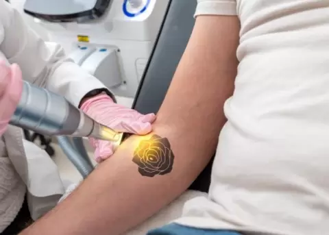 Cmo eliminar un tatuaje de forma segura y efectiva?