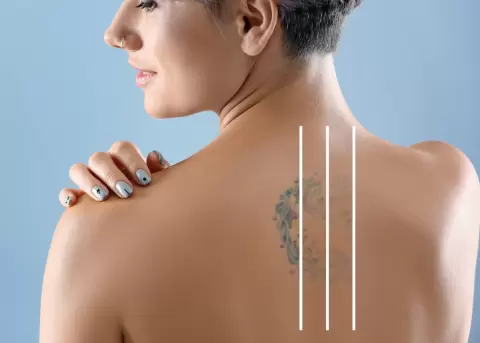 Eliminar tatuajes toma m�s de una sesi�n.