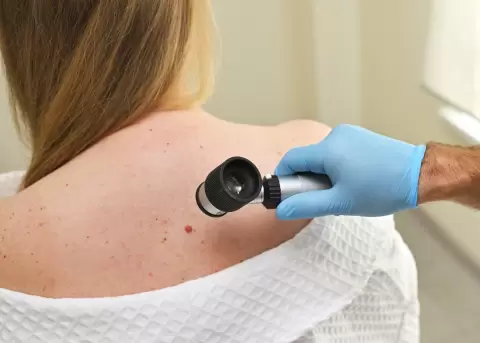 El c�ncer de piel y c�mo evitarlo.