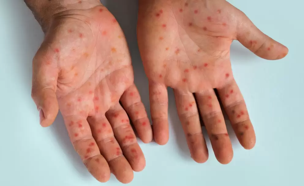 Extremar precauciones para evitar un brote de la nueva variante de la viruela s�mica, recomienda epidemi�logo