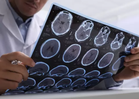 M�dico examinando im�genes de RM de pacientes con esclerosis m�ltiple.