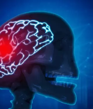 Estos son los signos y s�ntomas que no puedes ignorar para identificar un infarto cerebral.