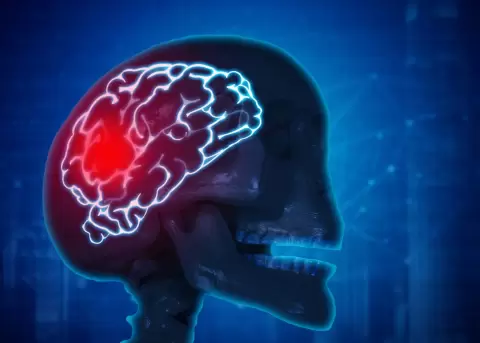 Estos son los signos y s�ntomas que no puedes ignorar para identificar un infarto cerebral.