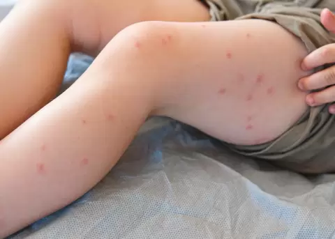 Sarampi�n, medidas de prevenci�n y tratamiento.